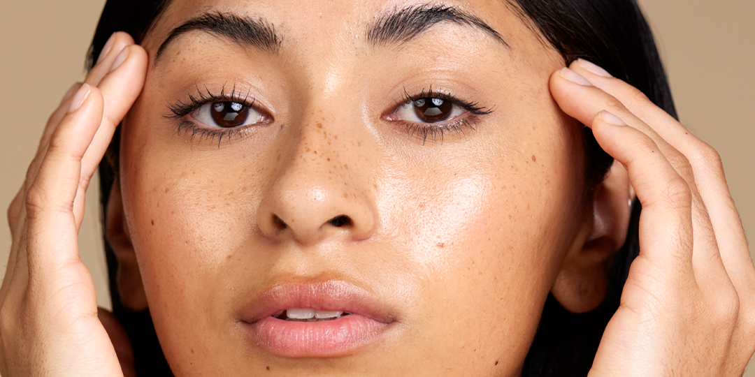 How to Get Rid of Hyperpigmentation Naturally: An Australian Guide